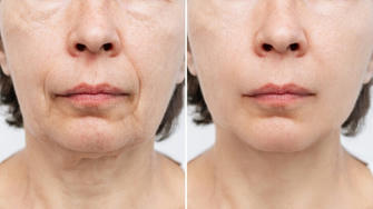 The Secret Weapon for Aging Gracefully: Why More People Are Choosing Facelifts