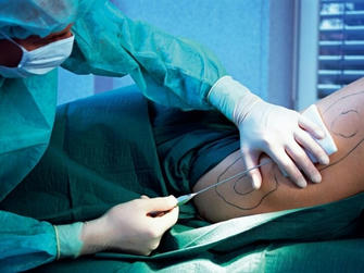 Title: Liposuction: A Revolution in Body Contouring