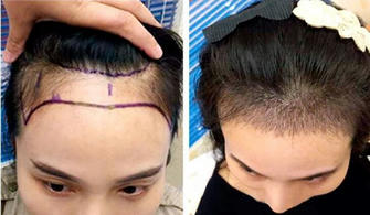 Title: Hair Transplantation: A Revolution in Modern Hair Restoration
