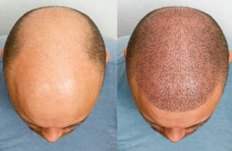 Regaining Confidence: Unveiling the Magic of Hair Transplantation