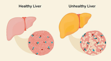 How To Keep Your Liver Healthy And Happy