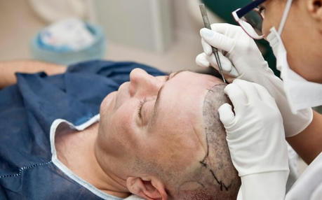 How to Achieve a Fuller, Thicker Hair with Hair Transplantation