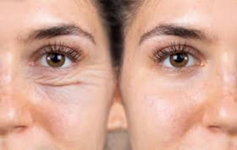 Say Goodbye to Tired Eyes: Eyelid Surgery That Rejuvenates