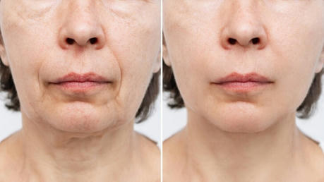 The Secret Weapon for Aging Gracefully: Why More People Are Choosing Facelifts