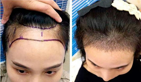 Title: Hair Transplantation: A Revolution in Modern Hair Restoration